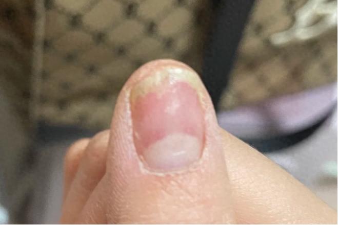 女子美甲導致真菌感染治療花費近萬元，本應制造美麗的美甲店為何制造出衛生麻煩？